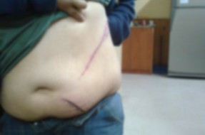 Imagen:Profundos cortes en el abdomen de la mujer
