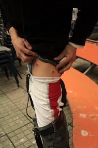 Herido con balines de goma Herido con balines de goma