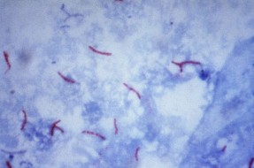 Imagen:Tuberculosis | Wikipedia