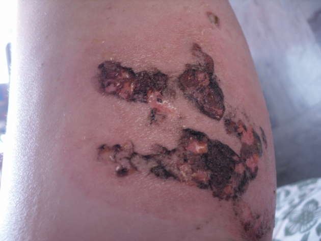 Quemadura en pierna por explosión de lacrimógena | Javiera Portales