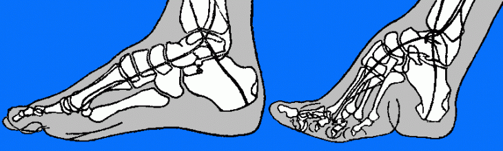Gráfica deformación del pie
