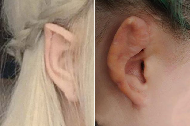 Mujer se sometió a peligrosa cirugía para tener oídos de elfo y terminó desfigurada