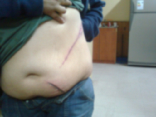 Profundos cortes en el abdomen de la mujer
