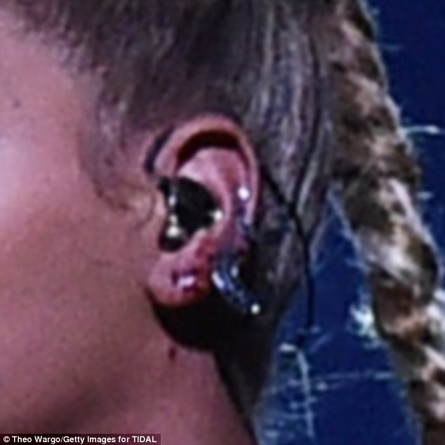 La lesión de Beyoncé en su oreja izquierda.