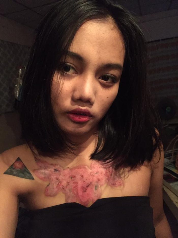 Adolescente muestra las terribles consecuencias de quitarse un tatuaje con técnica Rejuvi