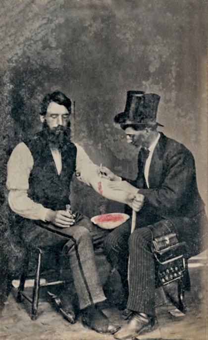 Médico realizando Bloodletting en 1860 (CC) Wikimedia Commons
