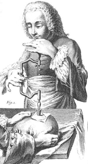 Ilustración del siglo XVIII de una trepanación en Francia (CC) Wikimedia Commons