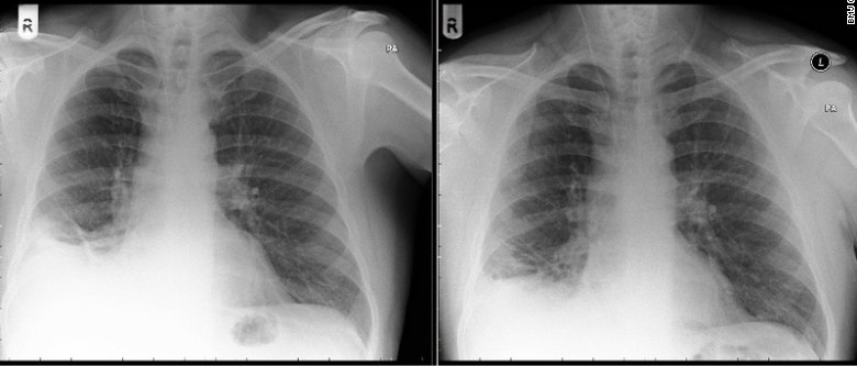 Radiografía del paciente antes (izquierda) y después (derecha) de de la extirpación del Lego | British Medical Journal