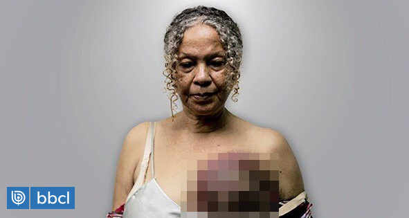 Extreme Photos Of Women With Untreated Breast Cancer Show A Crisis In Venezuela International