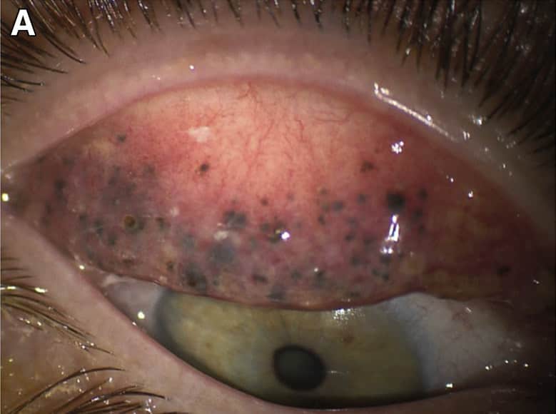 El ojo de Theresa | American Academy of Ophthalmology