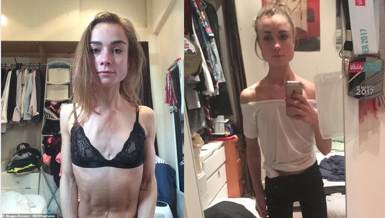 anorexia antes y despues