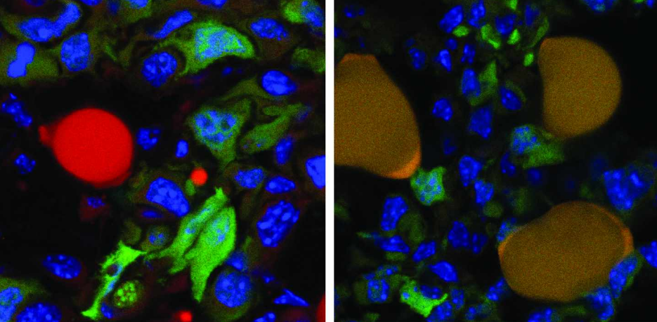 Células de cáncer (verde) convertidas en grasa (naranja) | Universidad de Basilea