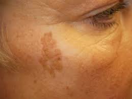 4 tipos de manchas en la piel por el sol | Vida | BioBioChile