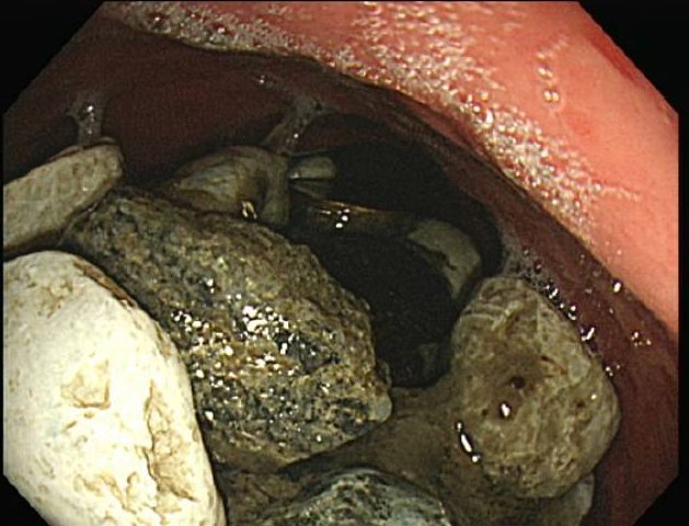Piedras en el estómago | American Journal of Medical Case Reports