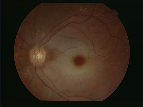CONTEXTO | Oclusión arterial retiniana | Sociedad de Oftalmología de Valencia