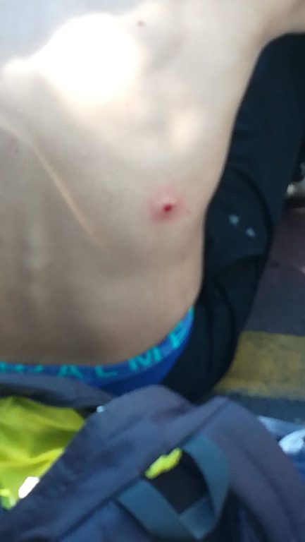 Cedida | Joven herido por balin de goma en su espalda