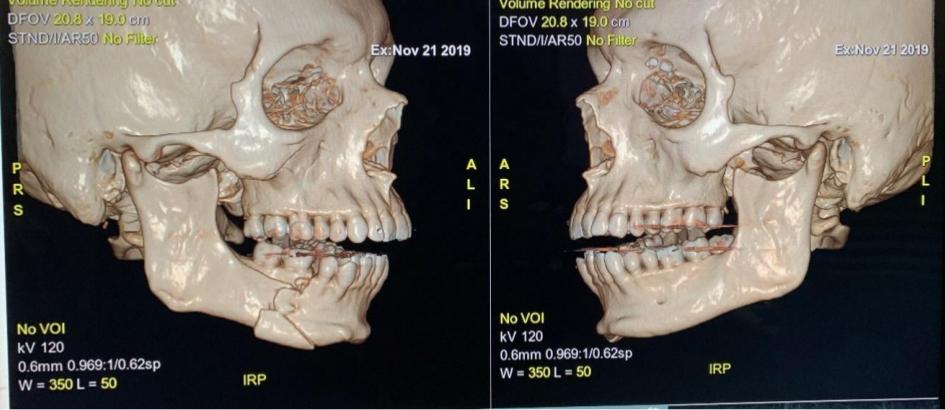 Imágenes de la mandíbula derecha fracturada de mujer tomadas en el Hospital Carlos Van Buren en Valparaíso. 21 de noviembre de 2019.