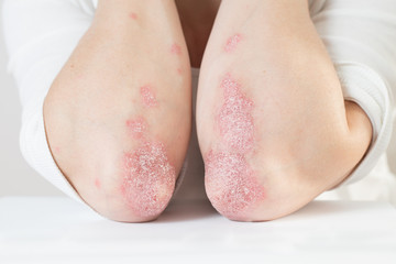 Psoriasis en codos | Freepik