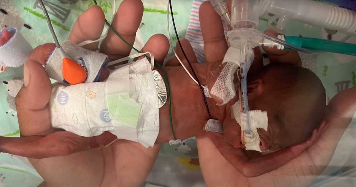 El pequeño nació a las 21 semanas y un día. En la foto, se ve al pequeño que mide menos que las manos que lo sostienen, a su vez que está lleno de cables de monitoreo y respirador.