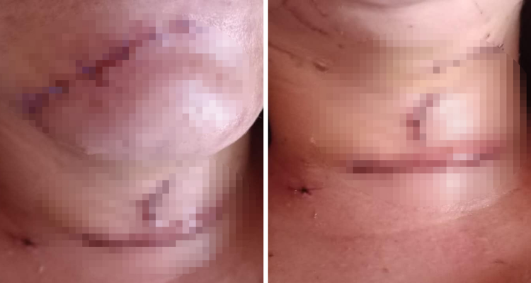 Víctima de femicidio frustrado en Purranque