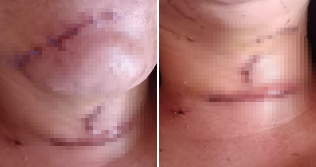 Víctima de femicidio frustrado en Purranque
