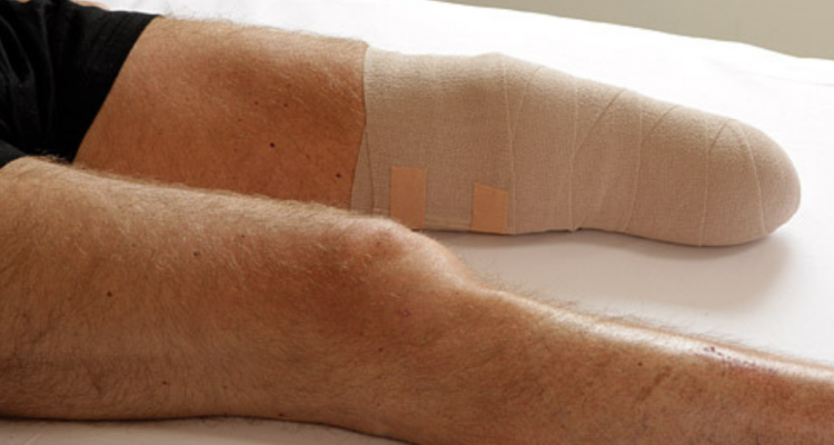 Amputación por error