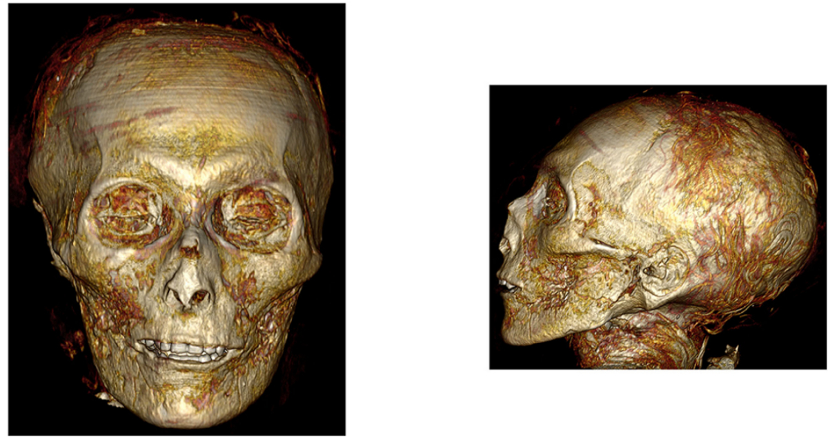 En la imagen se ve cómo luciría la momia por dentro. Son dos imágenes del cráneo bien conservadas con piel y sus dientes. 
