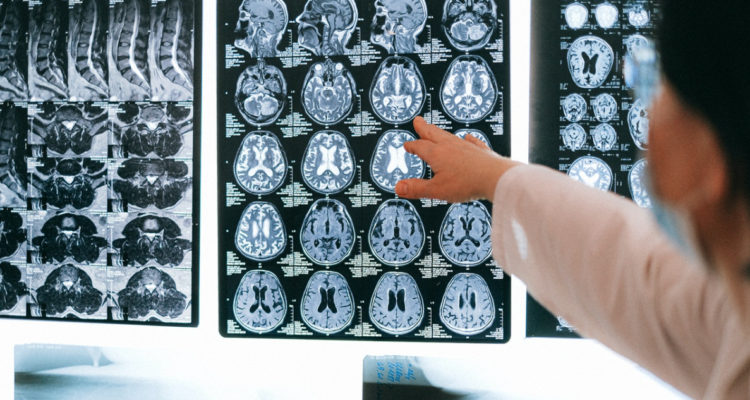 ¿El covid afecta la inteligencia? neuróloga asegura que sí