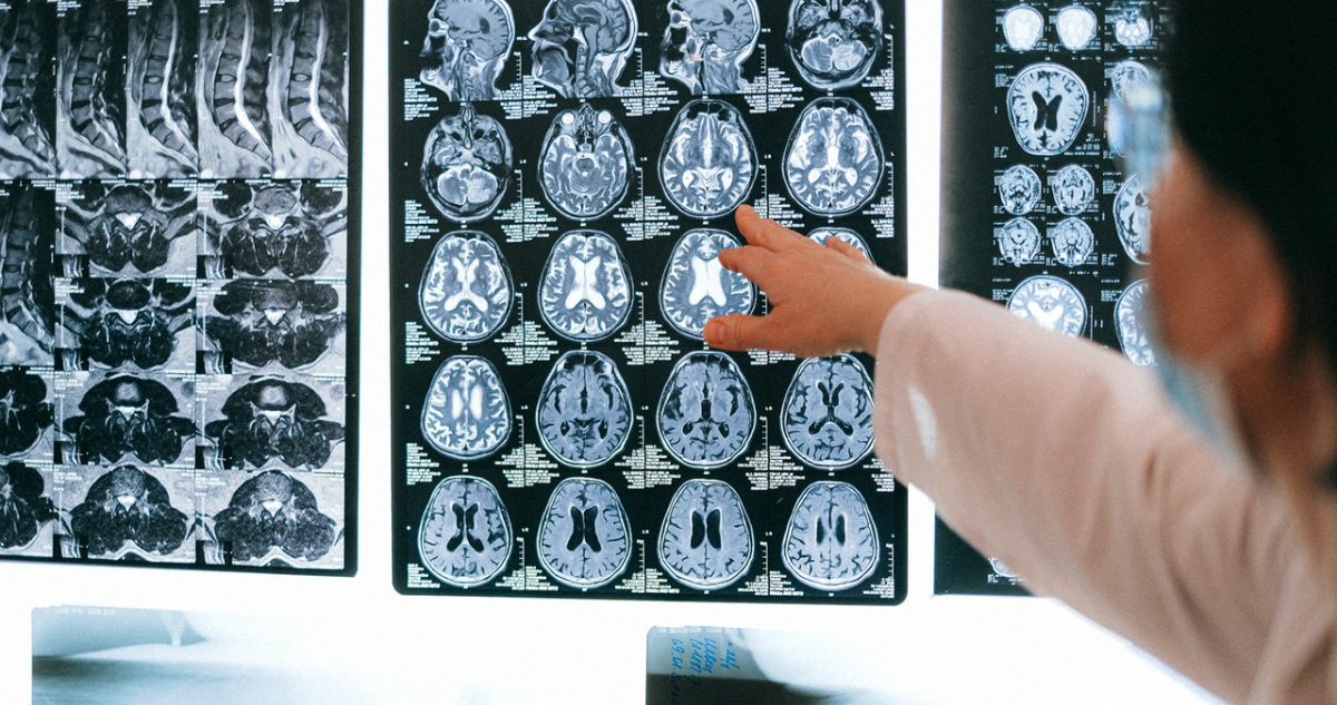 ¿El covid afecta la inteligencia? neuróloga asegura que sí