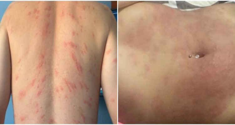 Denuncian aparición de ronchas tras visitar Laguna Avendaño