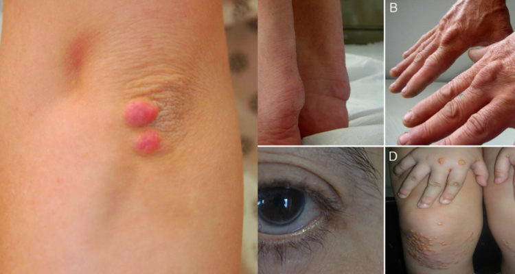 Xantomas pueden ser indicador de enfermedades graves