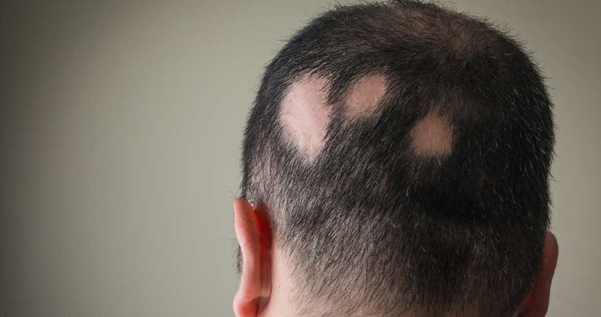 Alopecia areata: jada pinkett smith
