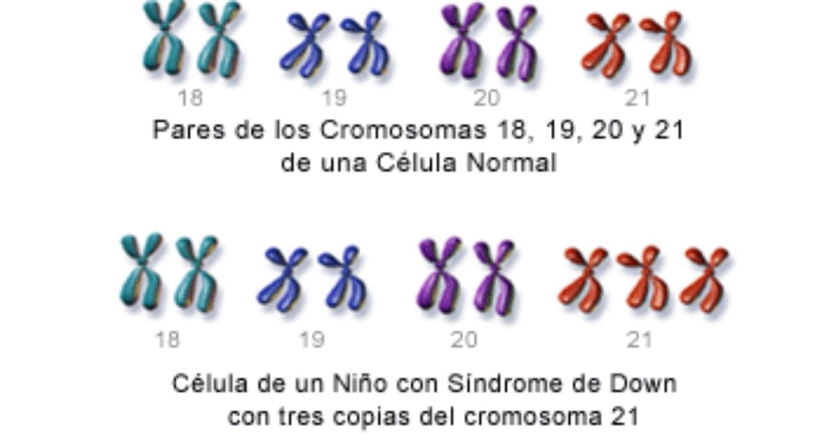 Cromosoma 21 síndrome de down
