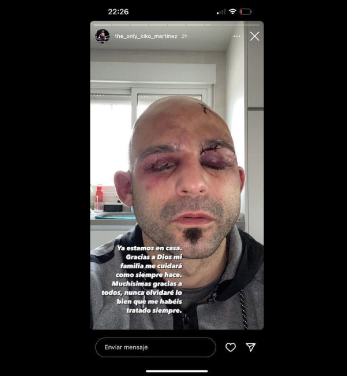 Kiko Martínez lució sus secuelas tras la pelea ante Warrington.