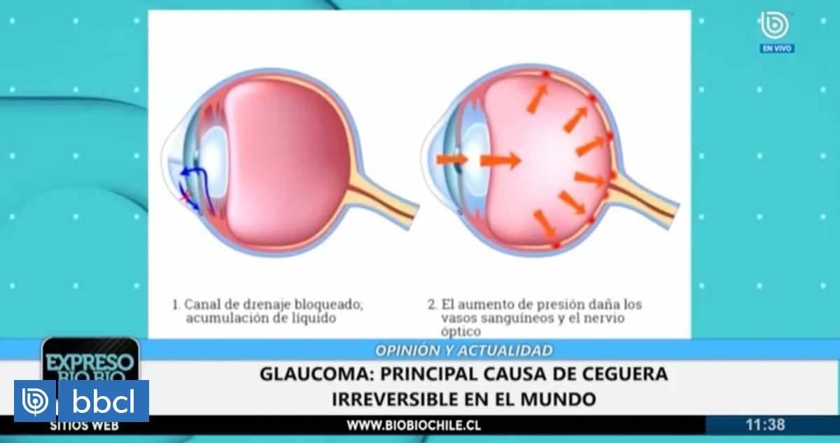 La Primera Causa De Ceguera Irreversible A Nivel Mundial Es El Glaucoma ¿cómo Prevenirlo 1412