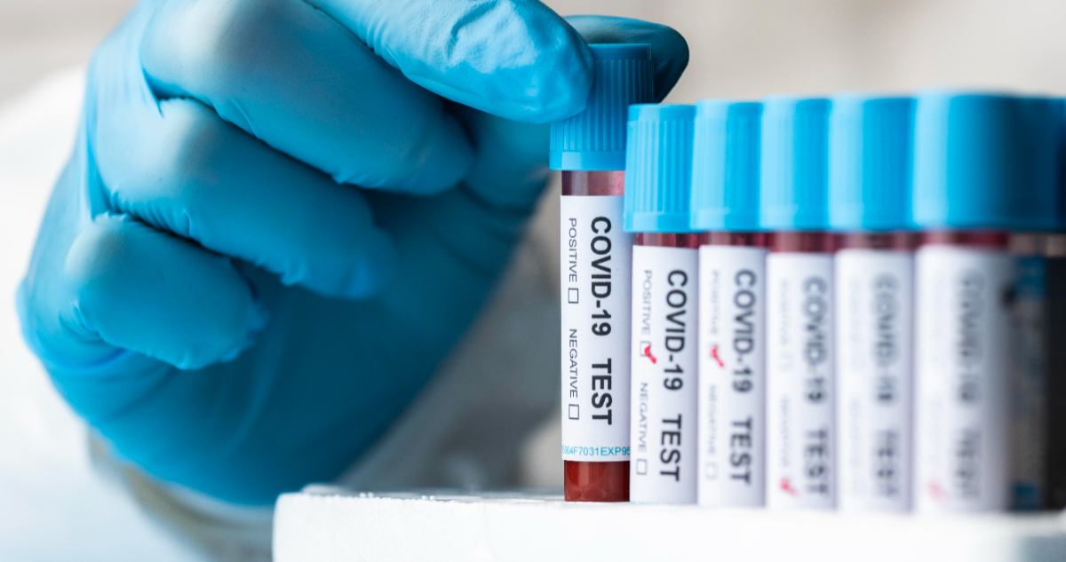 Anticuerpos de covid-19 en pacientes VIH