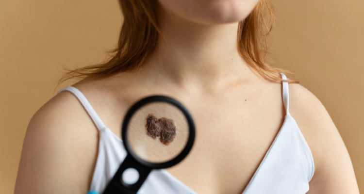 inteligencia-artificial-para-detectar-melanomas