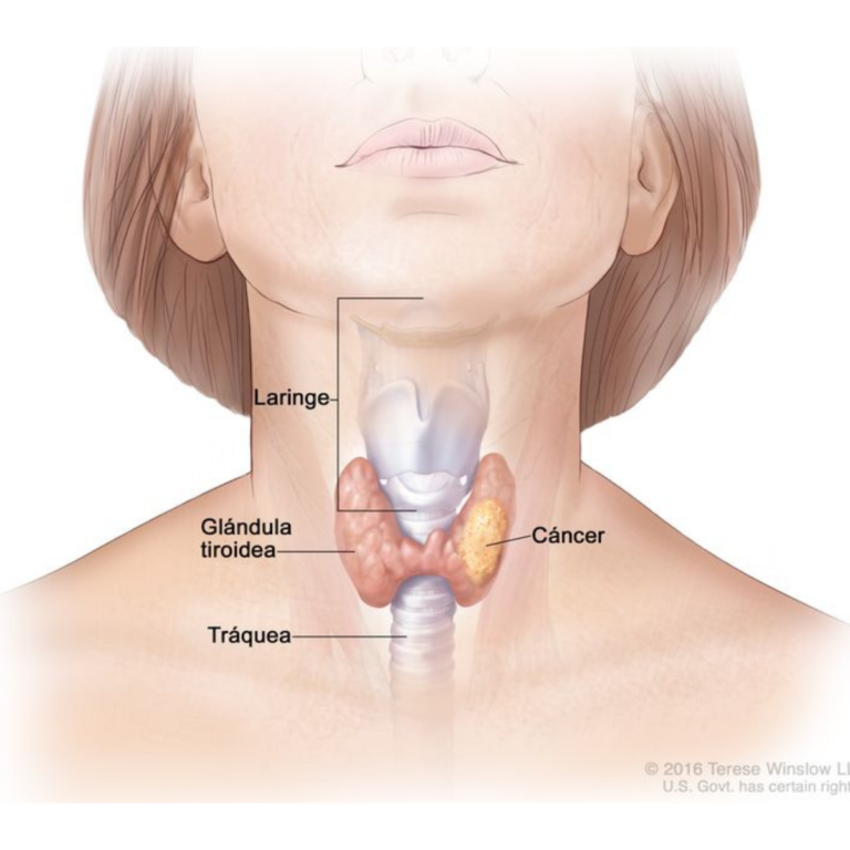 glandula-tiroides-cancer