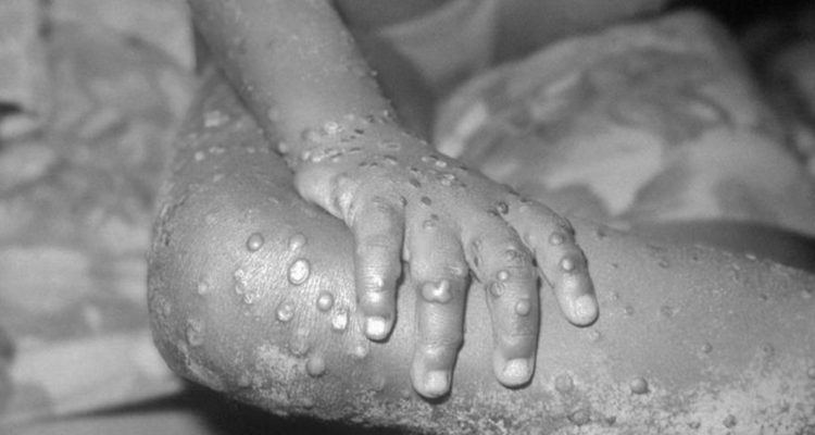 Detectan caso de viruela del mono en EEUU y Perú se pone bajo alerta preventiva