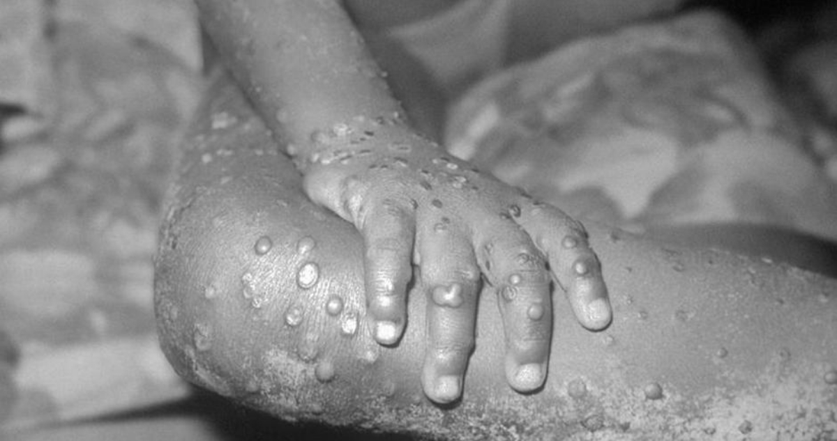 Detectan caso de viruela del mono en EEUU y Perú se pone bajo alerta preventiva