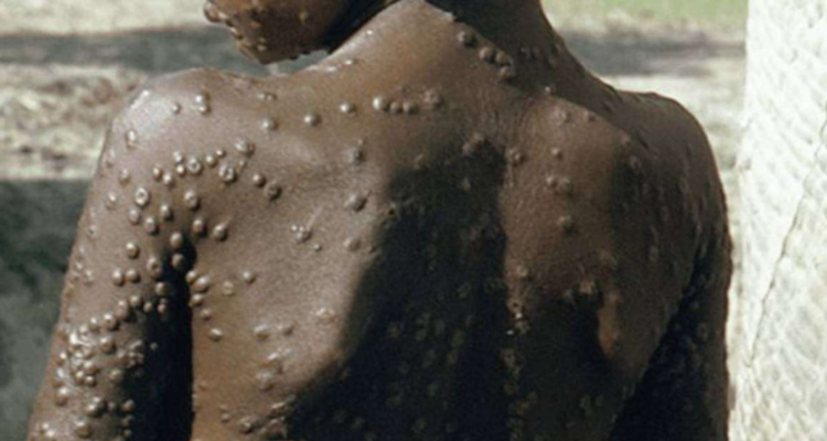 OMS sobre Viruela del Mono