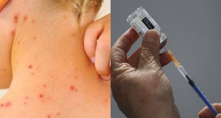 ¿Hay vacuna o tratamiento para la Viruela del Mono?