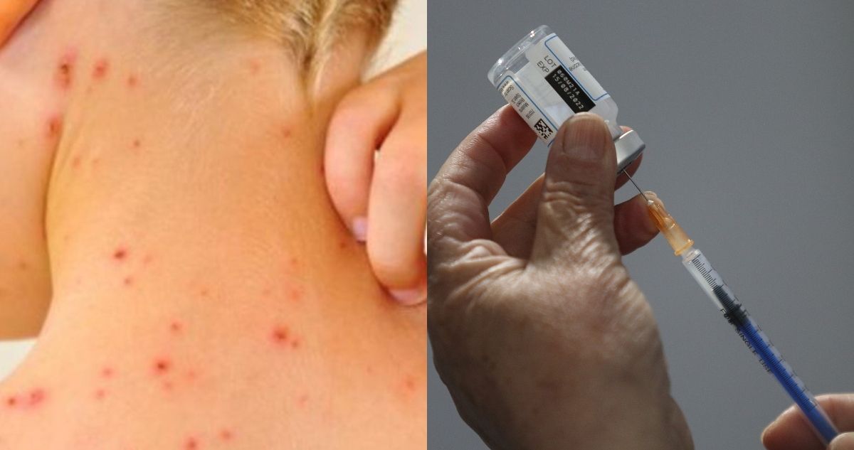 ¿Hay vacuna o tratamiento para la Viruela del Mono?
