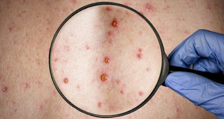 Viruela del mono llega a Argentina: autoridades sanitarias confirmaron su primer caso