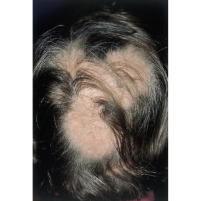 Alopecia areata-Alopecia areata-Severe
