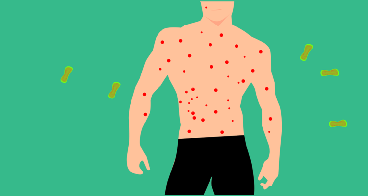 Foto contexto viruela del mono