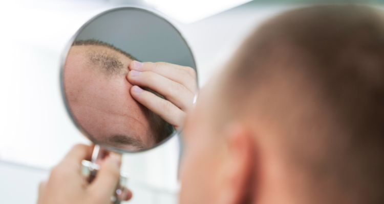 medicamento-alopecia-areata-baricitinib