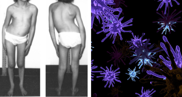 paciente-de-polio-ilustracion-virus