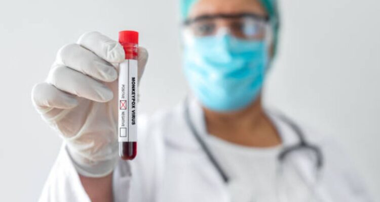 viruela-del-mono-en-chile