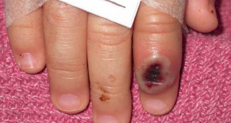 Foto mano con lesiones cutáneas por viruela del mono